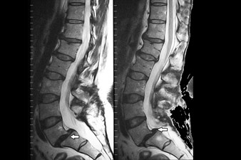 Az ágyékcsigolyák MR-vizsgálata