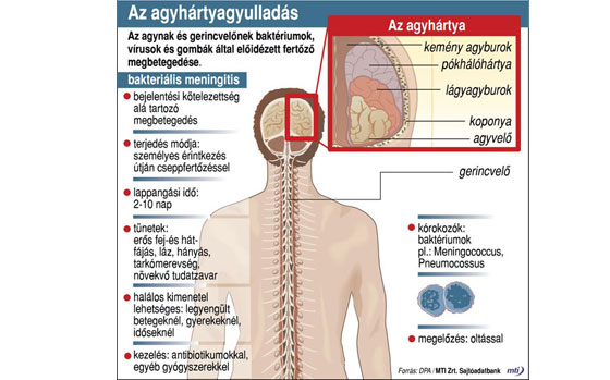 az agyhártyagyulladás hatása a látásra