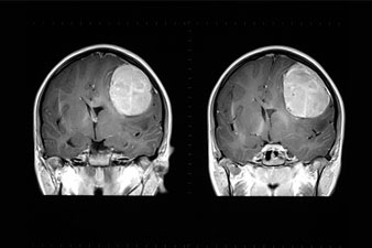 Agyi MR/MRI vizsgálat