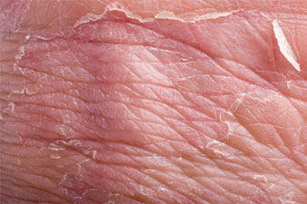 Milyen okai lehetnek a bőrgyulladásnak