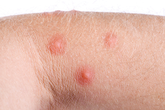 Mi okozhat allergiás bőrkiütést?