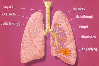 tüdő hörgő gyulladás