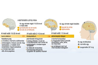 alzheimer-kór és magas vérnyomás