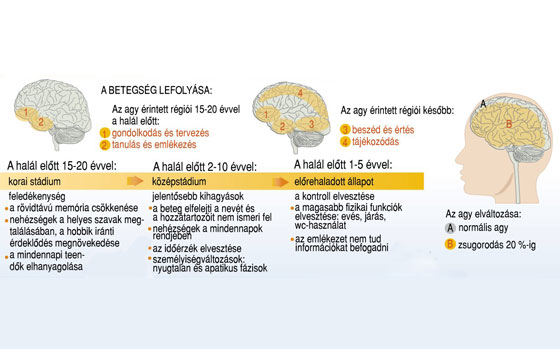 Alzheimer-kór infografika
