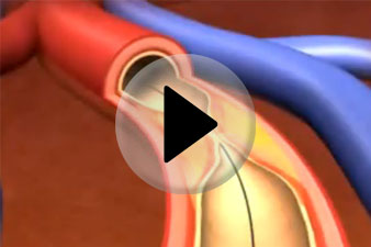 szív egészsége stent után magas vérnyomás kezelése kémia nélkül