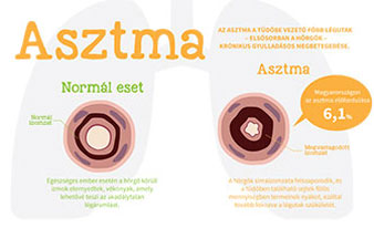 Hasznos tudnivalók az asztmáról