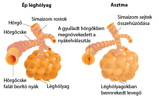 a hörgőasztma kezelésére cukorbetegség)