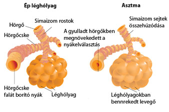 A léghólyagok asztma esetén