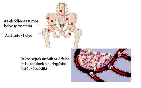 Prosztata rákos metasztázisok csontokban erős fájdalom