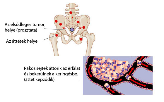 Áttétképződés ábra