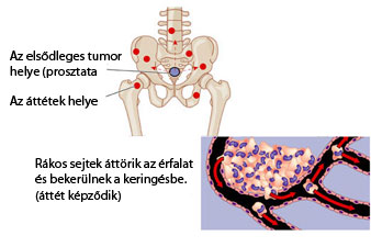 látás áttétek