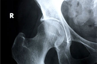 Mikor van szükség a combnyak röntgenre?