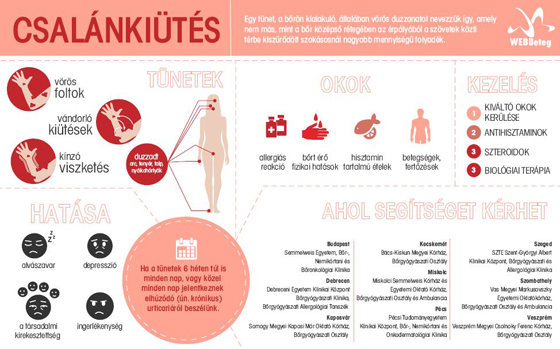 Csalánkiütés infografika