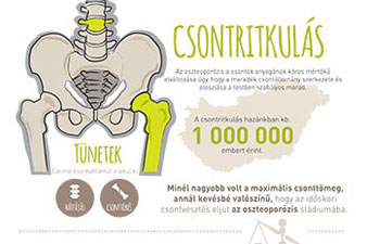 A csontritkulásról részletesen