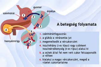 A cukorbetegség típusai, kialakulása, szövődményei