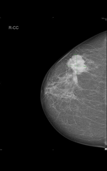 Mammográfia: daganatos elváltozás