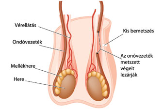 hormonális fogamzásgátlók és visszérbetegségek szedése