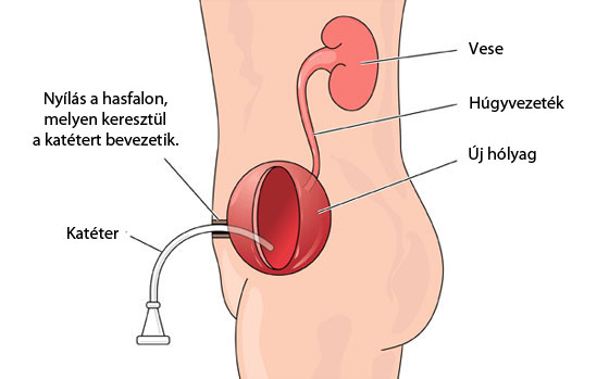 Mitrofanoff műtét