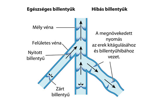 visszér billentyű)