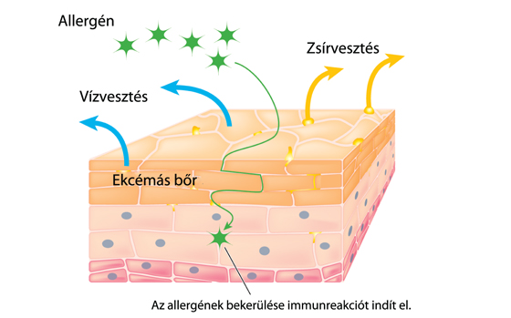 Allergének ekcéma esetén