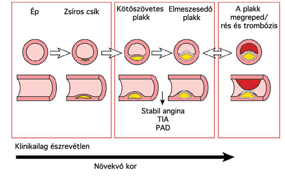 Érelmeszesedés folyamata, trombózis