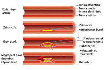 Az érelmeszesedés stroke-hoz is vezethet