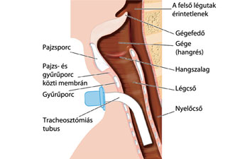 A gégekanül a légzés biztosítását szolgálja