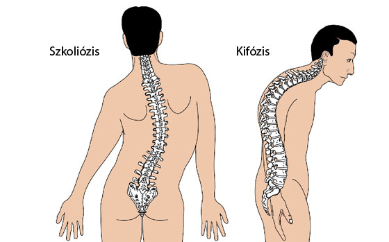 Gerinc deformáló artrózisának kezelése, A porckorongkopás okai, kezelése