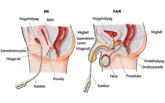 katéter után vizelés)