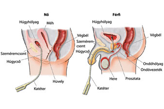 prostate calcification causes prostatitis és aloe lé