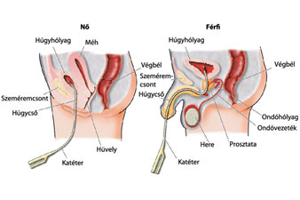 húgyúti katéter és prosztatitis)