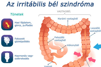 Irritábilis bél szindróma (IBS) infografika