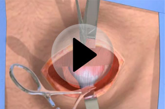 laparoszkópos veseműtét Fészek a prosztatitisből