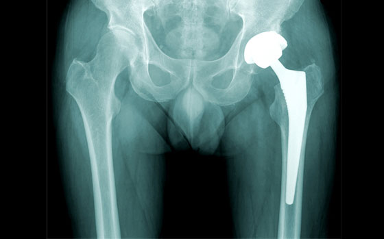Combnyak protézis röntgen
