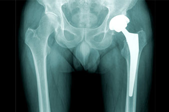 mit kell csinálni a csuklóízület fájdalmával korszerű technológiák az artrózis kezelésére