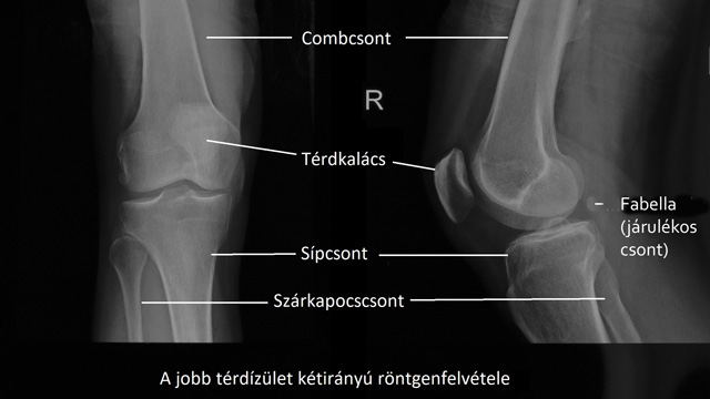Röntgenfelvétel: térd