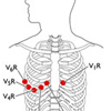 EKG felhelyezése