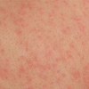 Allergiás ekcéma