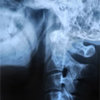 Nyakcsigolyák röntgenfelvételen