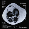 Térd,MRI