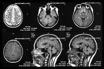 A traumás agykárosodás fő jelei, Látáskárosodás traumás agyi sérüléssel
