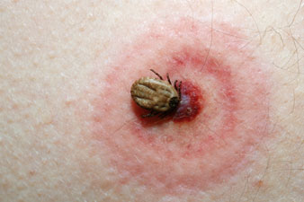 A Lyme-kór korai tünetei