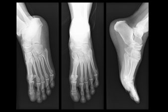 Mikor van szükség a lábfej röntgenvizsgálatára?