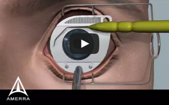 videó a szemműtét rövidlátásáról
