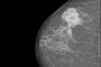 Emlőrákos elváltozás mammográfiás felvételen