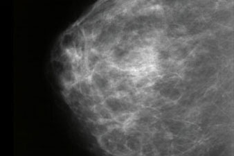 Mammográfia - körülírt benignus meszesedés - Mellrák, emlőbetegségek