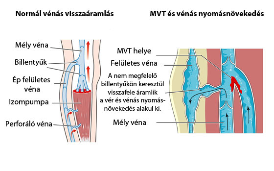 hogyan alakulhat ki az alsó végtagok visszér