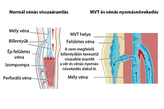 Számos hajlamosító tényezője lehet a mélyvénás trombózisnak