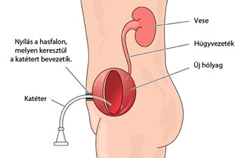 prosztata műtét menete prostata ingrossata catetere