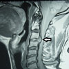 Nyakcsigolyák MRI-felvételen